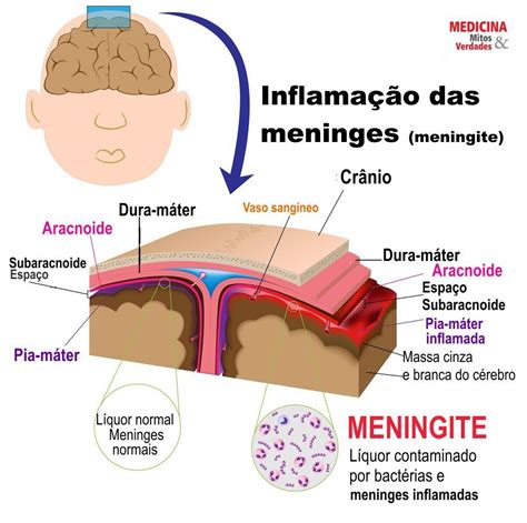 o que causa meningite viral